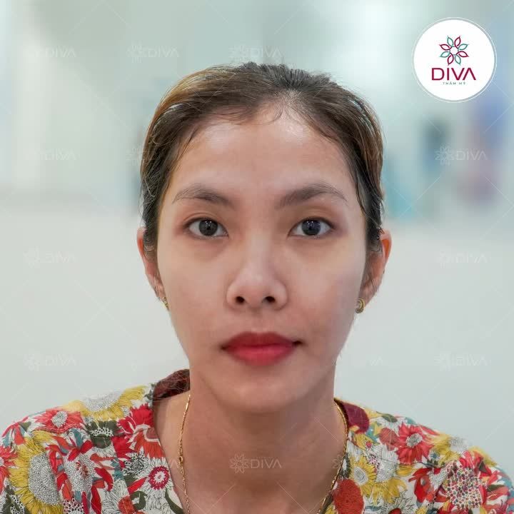 CẢI THIỆN MẮT 1 MÍ, MẮT MÍ LÓT NHỜ PP NHẤN MÍ