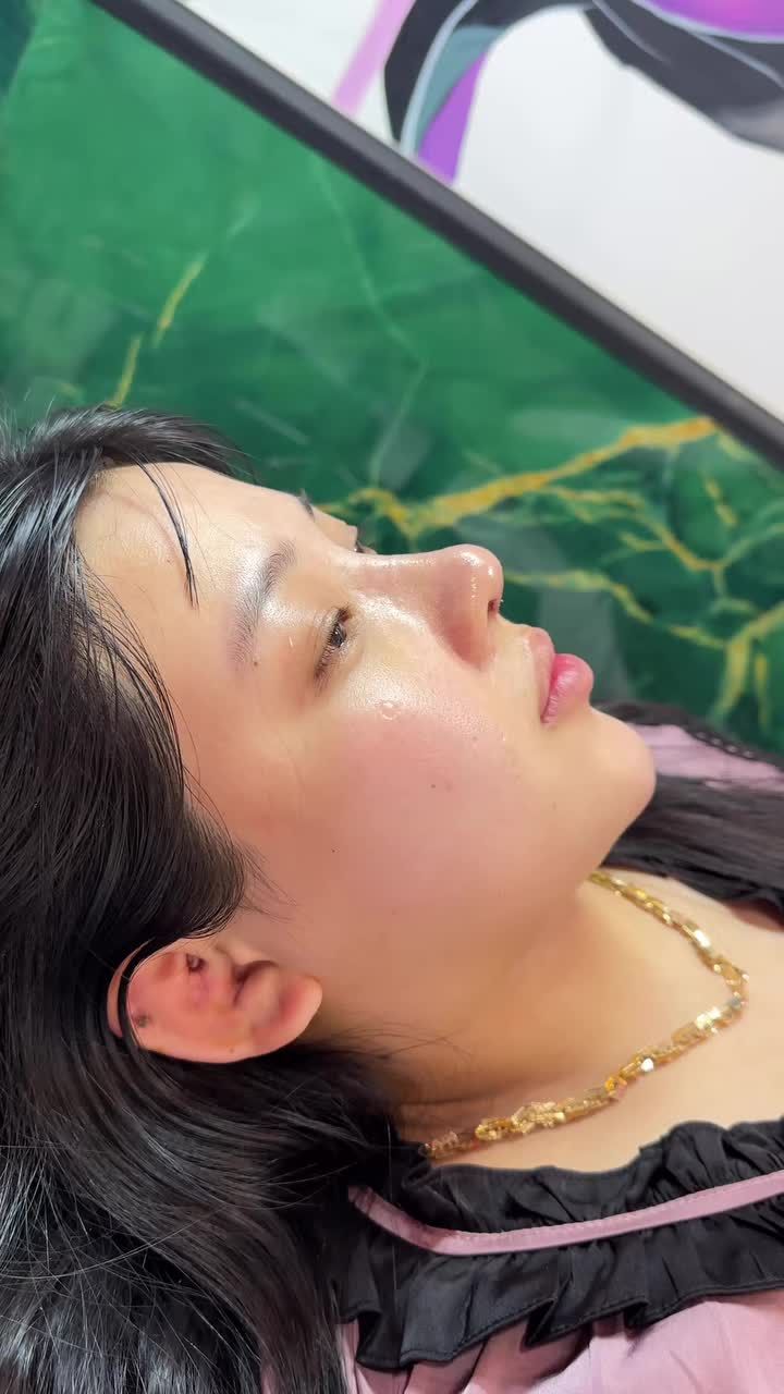 Nâng mũi cấu trúc sau 4 ngày