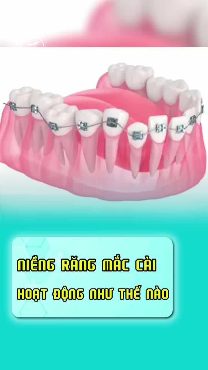 10 giây để biết cơ chế hoạt động của niềng răng mắc cài cùng Nha khoa Smile One nào cả nhà!