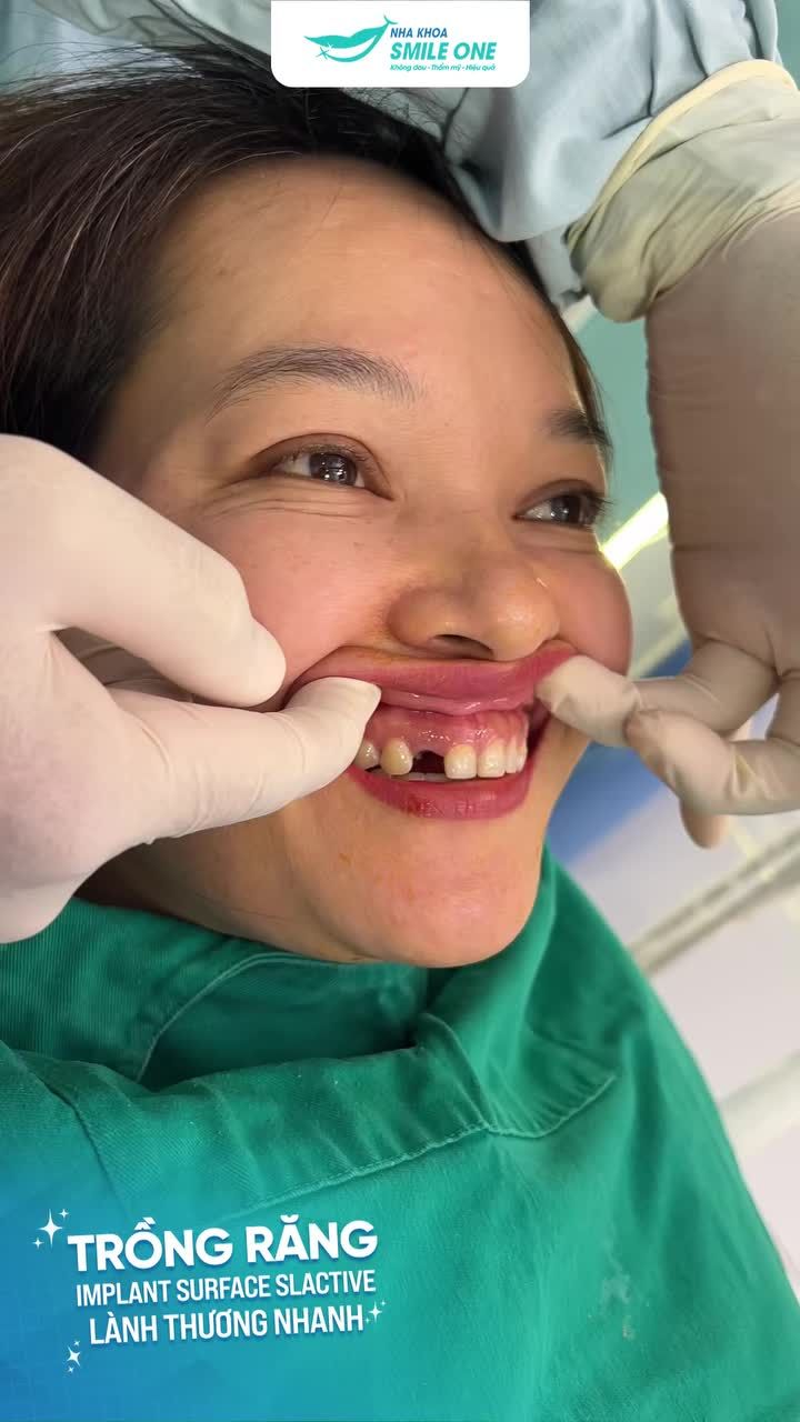 Răng cửa là vùng răng liên quan đến thẩm mỹ khá nhiều. Mất răng vùng này nếu không khôi phục kịp thời vừa ảnh hưởng ăn nhai lẫn sự xinh đẹp trên khuôn mặt đấy các khách hàng nhé!