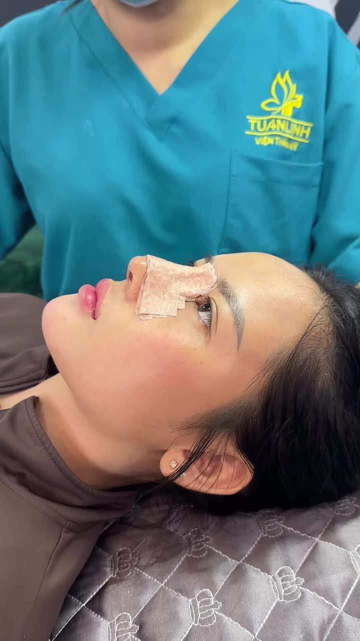 Cận cảnh nâng mũi cấu trúc sau 10 ngày