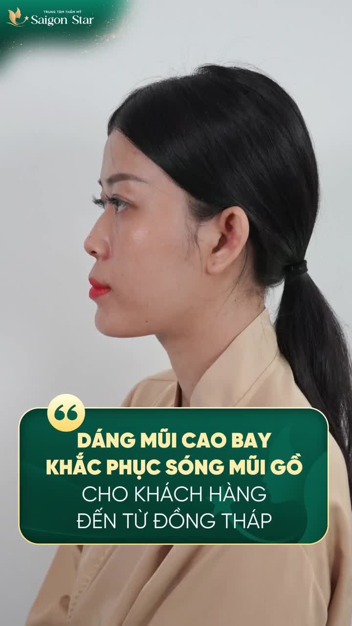 MŨI ĐẸP CAO BAY - KHẮC PHỤC MŨI GỒ CHỈ SAU 60 PHÚT