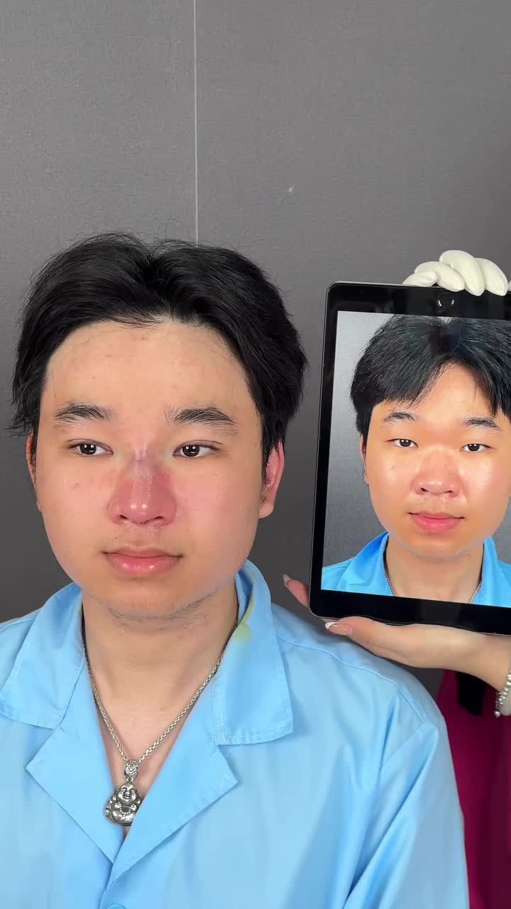 Ca cắt mí nam vừa hoàn thành