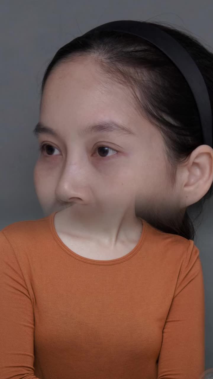 COMBO CẤY MỠ + TIÊM PROFHILO MANG LẠI SỰ TƯƠI TẮN, CĂNG MƯỚT VÀ TRẺ TRUNG CHO KHUÔN MẶT!