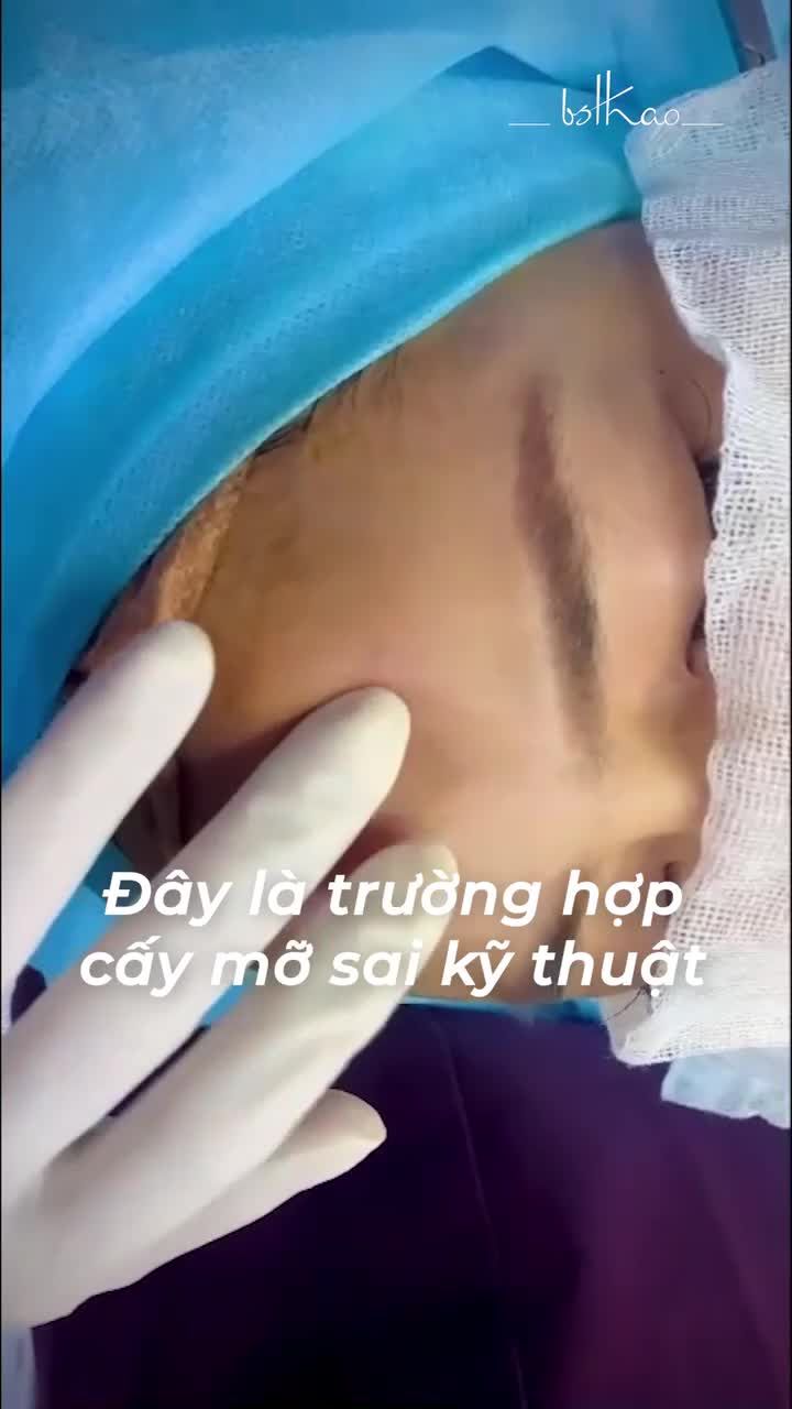 CẤY MỠ TRÁN BỊ LỖI SẼ NHƯ THẾ NÀO? KHI CẤY MỠ ĐÚNG KỸ THUẬT SẼ RA SAO?
