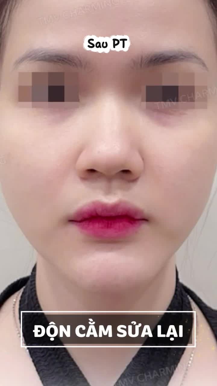 Nàng tìm đến Charming trong tình trạng cằm cũ khá lệch và không ôm theo đường xương hàm, khiến khuôn mặt nhìn chưa được thanh thoát.