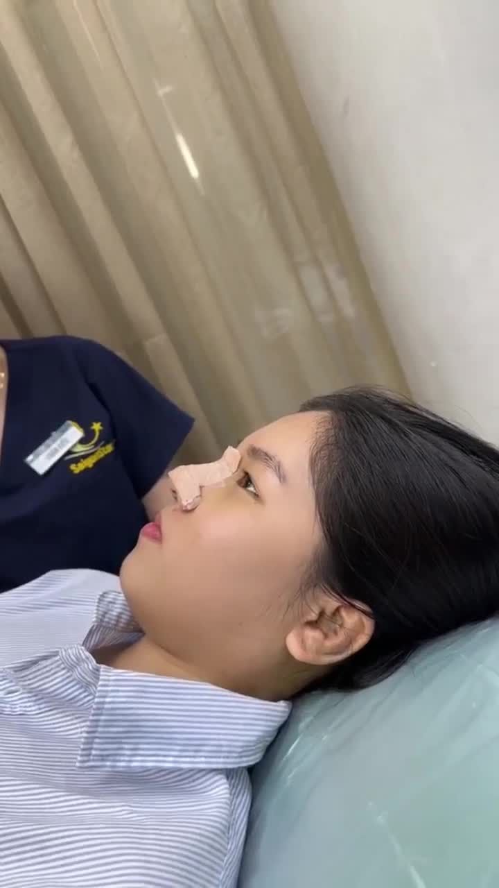 THÁO NẸP SAU 10 NGÀY NÂNG MŨI CẤU TRÚC SỤN SURGIFORM