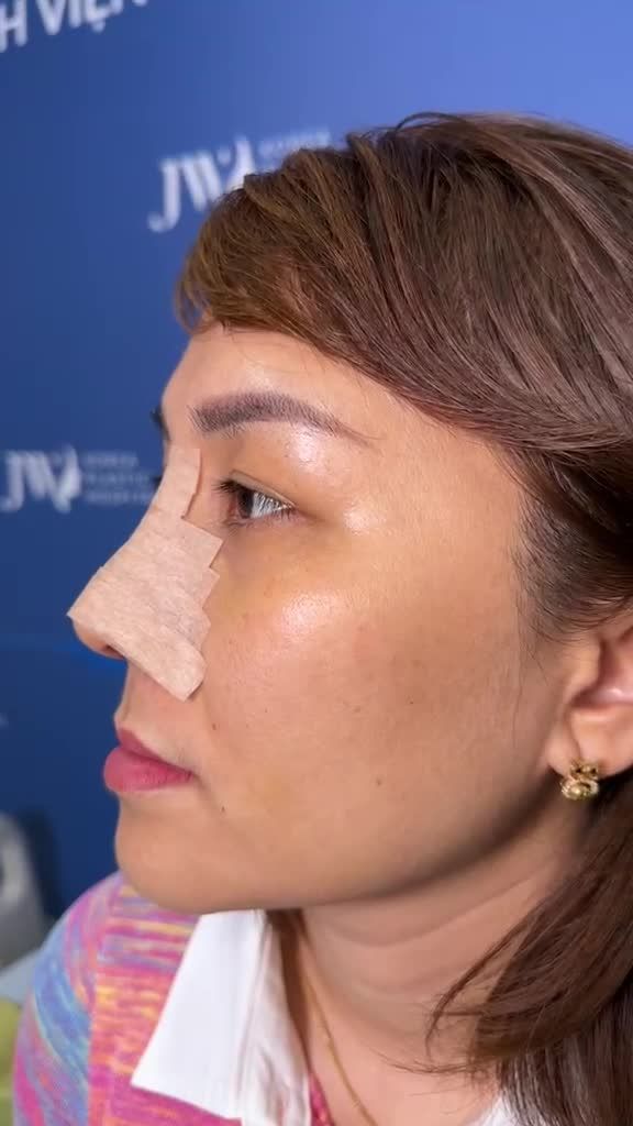 ĐỈNH: Chị gái 9X Gia Lai XÓA MŨI LỆCH, GÃY X.ƯƠNG hóa Hotgirl với Nâng mũi S Line 3D tại JW