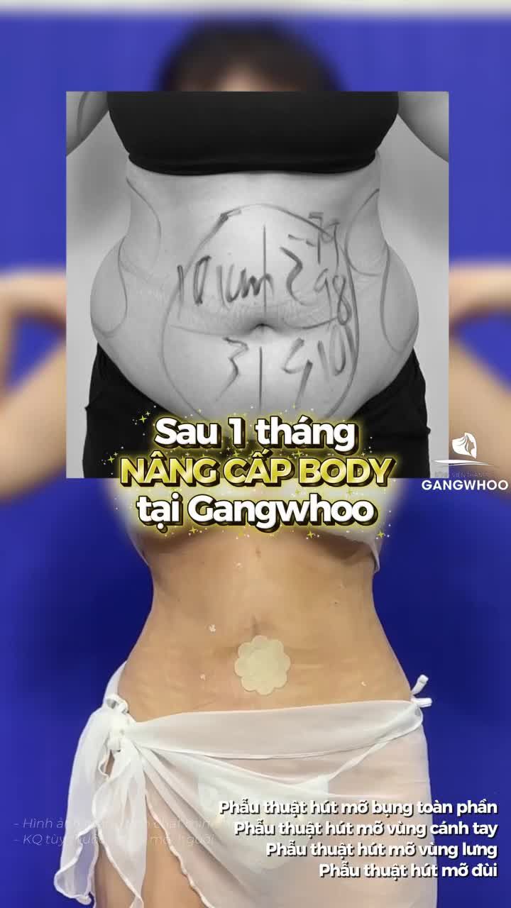 Khách nhà Gangwhoo sau 1 tháng phẫu thuật hút mỡ bụng toàn phần, phẫu thuật hút mỡ vùng cánh tay, phẫu thuật hút mỡ vùng lưng, phẫu thuật hút mỡ đùi