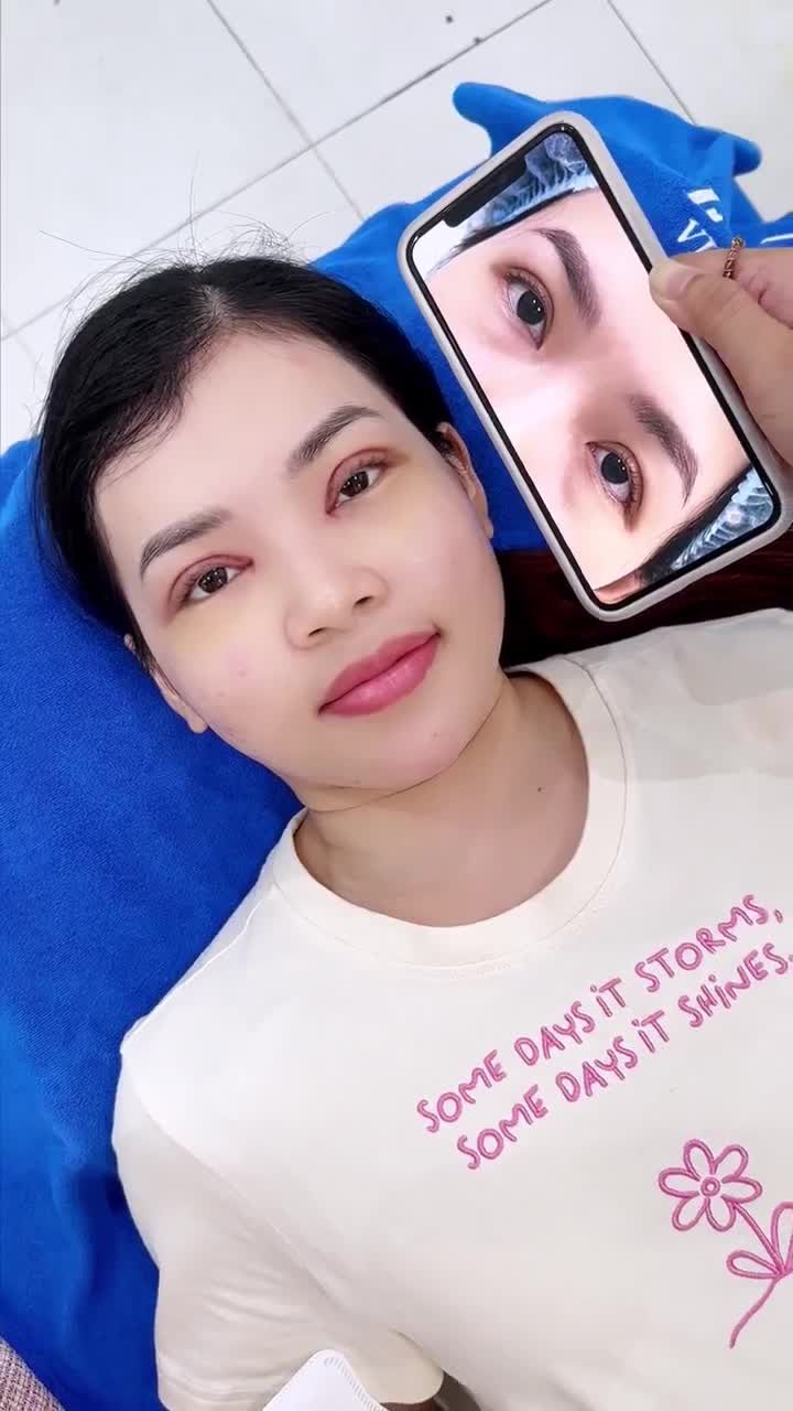 Ca cắt mí sửa lại sau 7 ngày