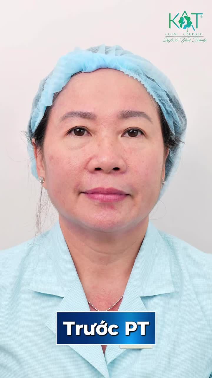 Có phải bạn từng xem ảnh sau cắt mí, thấy chỉ khâu nhiều – mí sưng rồi… sợ không dám làm?