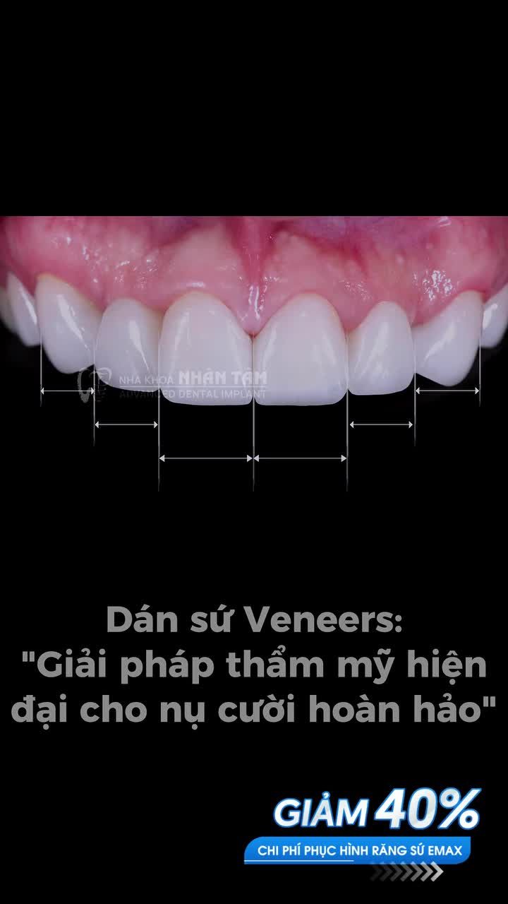 DÁN SỨ VENEERS – GIẢI PHÁP HIỆN ĐẠI CHO NỤ CƯỜI HOÀN HẢO