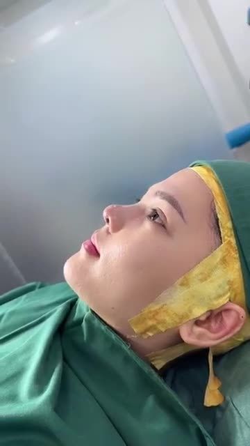 KẾT QUẢ NÂNG MŨI SỬA LẠI