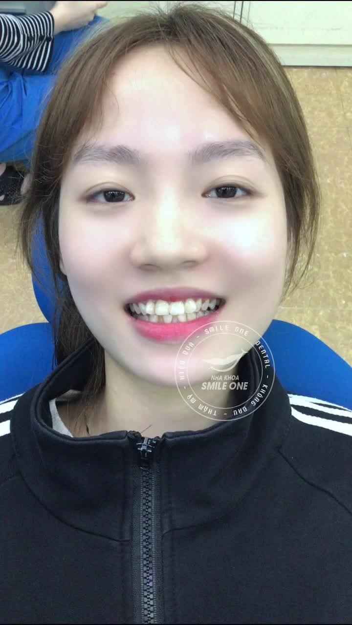 Nhật ký niềng răng của vị khách hàng xinh xắn Thu Huyền đến từ Hà Nội