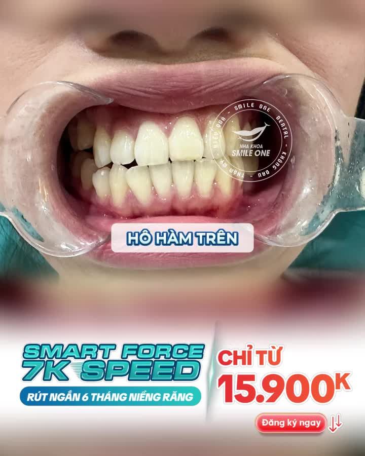 Gần 30 tuổi quyết định đi niềng răng chỉ vì lỡ va phải nụ cười xinh của một bạn khách hàng nhà Smile One