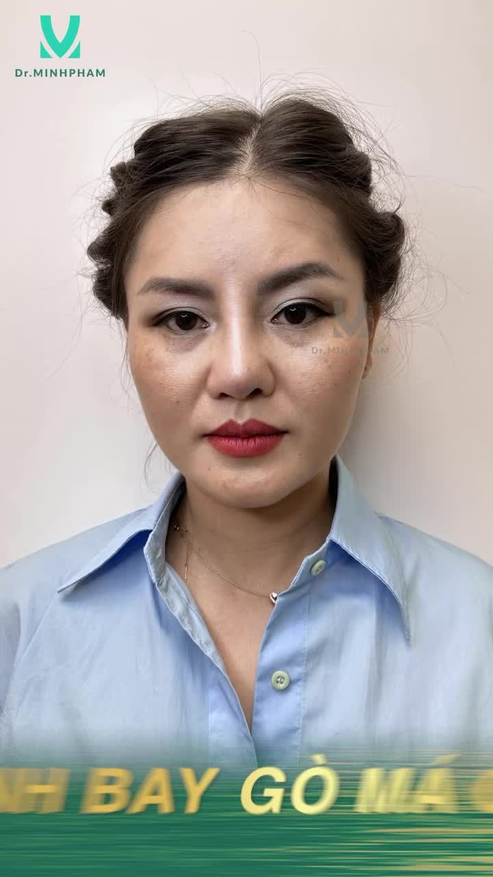 FOLLOW hành trình “Đánh bay” gò má cao do trực tiếp Ts.Bs Phạm Ngọc Minh thực hiện