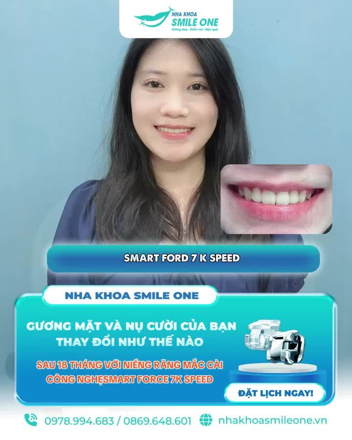 Bạn có tò mò răng mình dịch chuyển như thế nào khi niềng răng không?