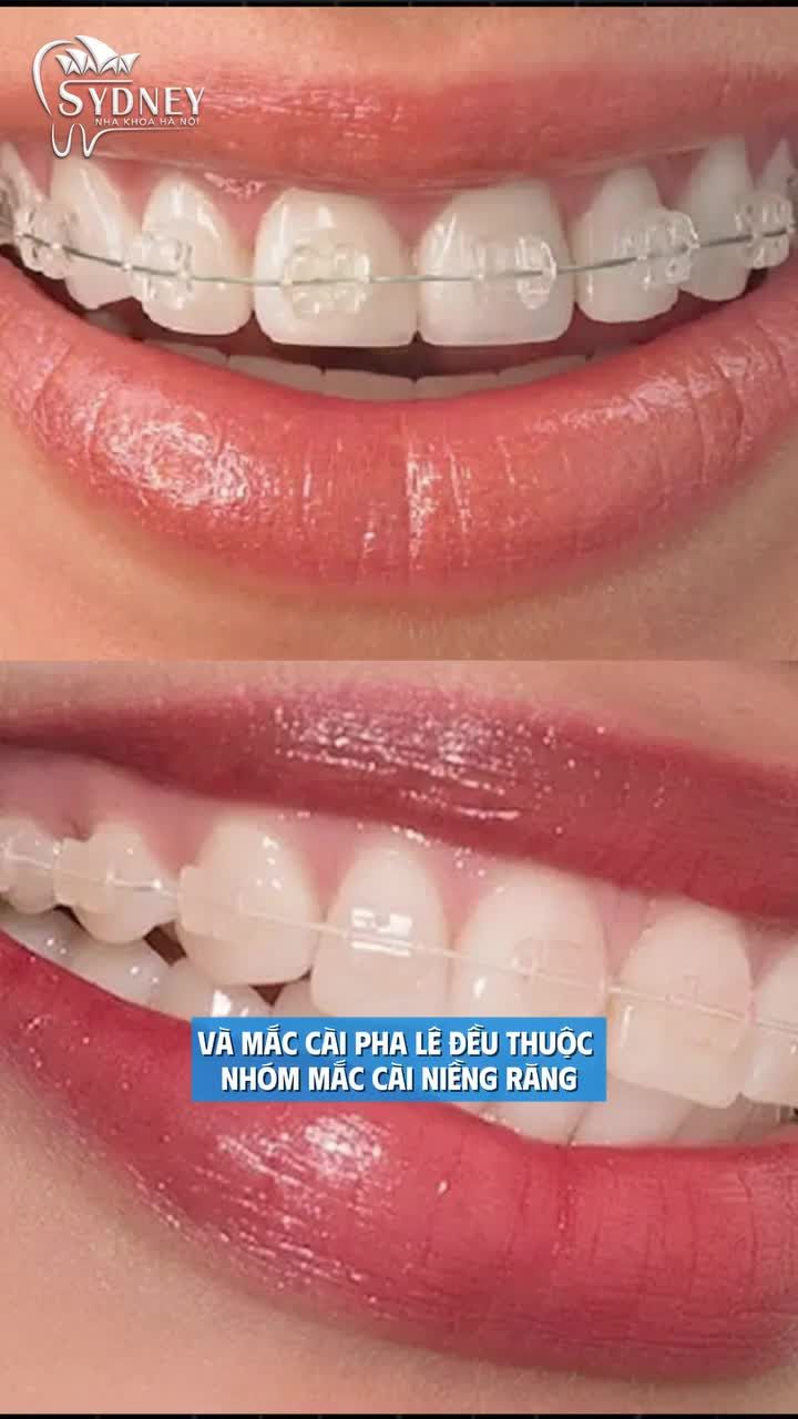 So sánh độ thẩm mỹ của mắc cài sứ và mắc cài pha lê