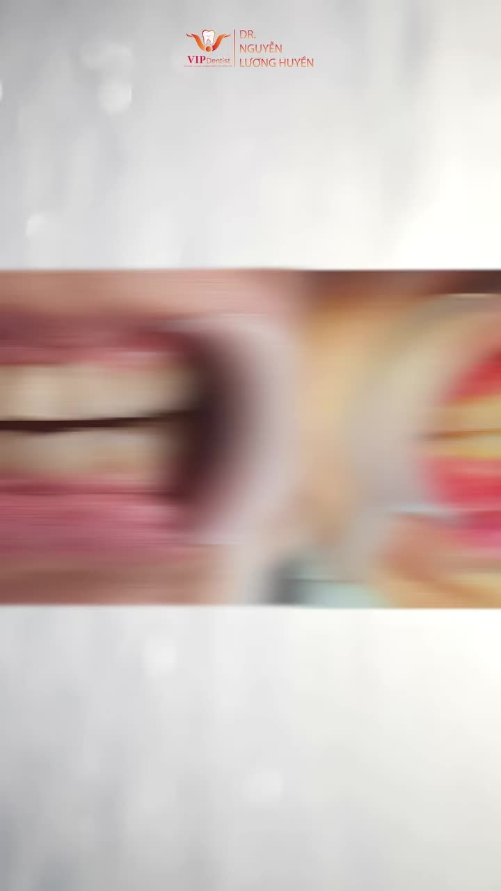 Niềng Răng Không Nhổ Răng thay đổi từ nụ cười đến gương mặt như thế nào?