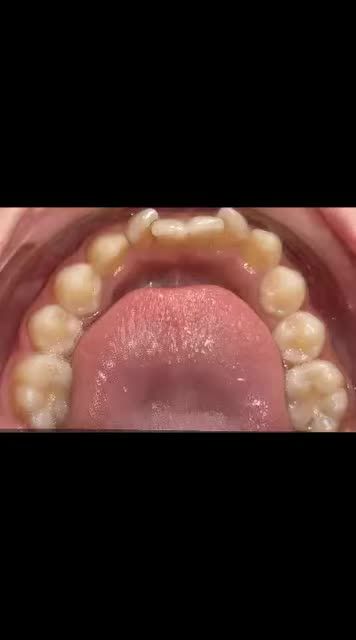 Sự dịch chuyển trong chỉnh nha