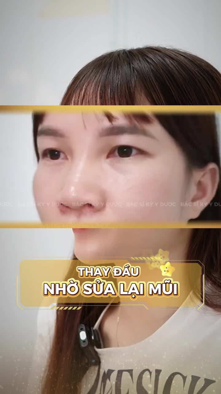 SỐNG MŨI LỆCH RÕ – GƯƠNG MẶT MẤT HẲN ĐỘ HÀI HÒA!