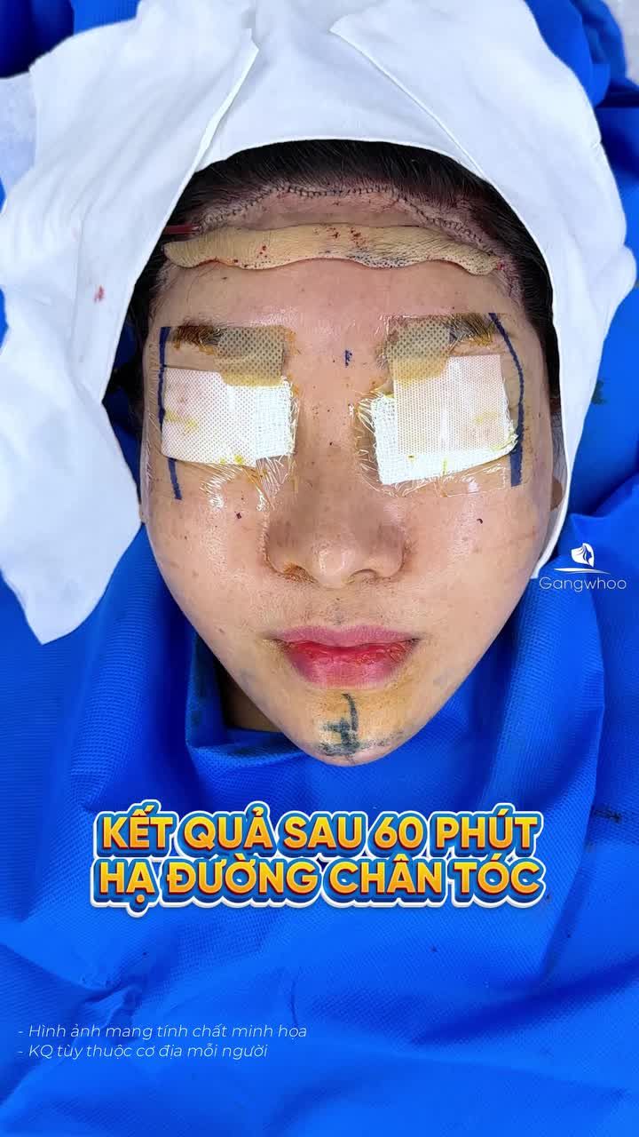 Kết quả sau 60 phút hạ đường chân tóc nội soi vi phẫu