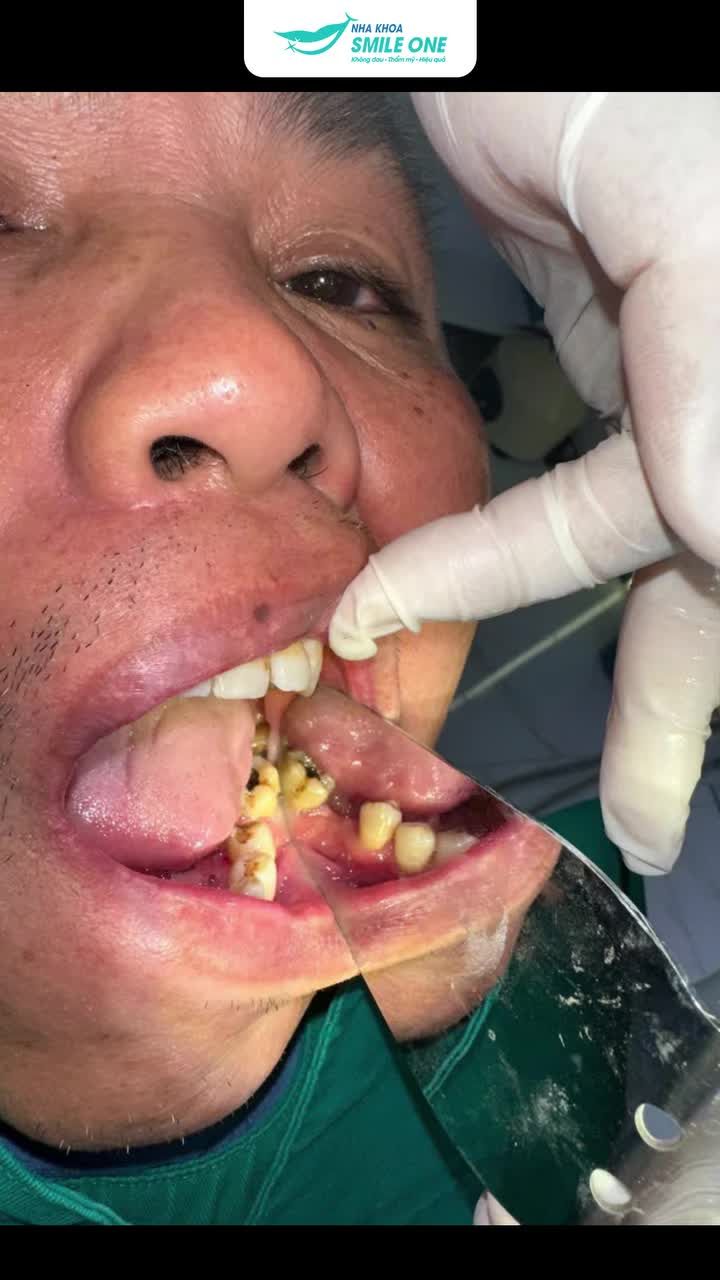 Khôi phục răng mất là việc cấp bách, không để quá lâu, không cần chờ đợi - Khách của Nha khoa Smile One đã nói thế đó!