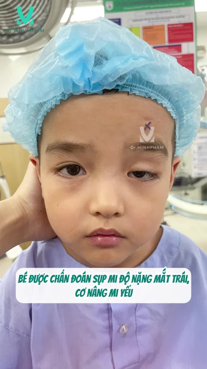 Cùng ngắm nhìn kết quả sau 5 tháng phẫu thuật treo mi vạt cơ trán của bé Tiến Đạt 4 tuổi