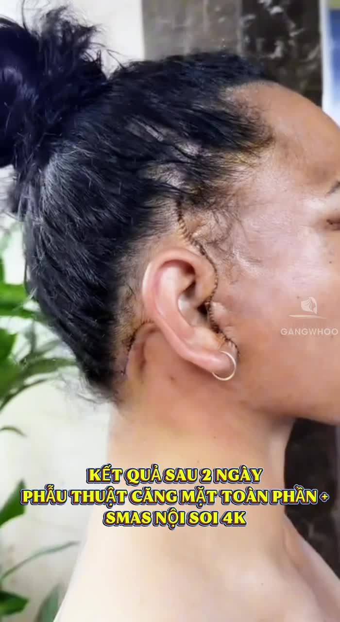 Kết quả sau 2 ngày phẫu thuật căng mặt toàn phần + Smas nội soi 4K của khách hàng Quốc Tế