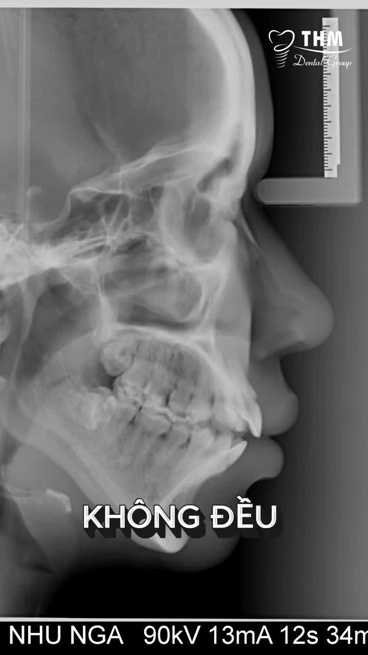 TƯ VẤN CHỈNH NHA CHO TRƯỜNG HỢP CẮN HỞ – CHEN CHÚC – LÙI CẰM