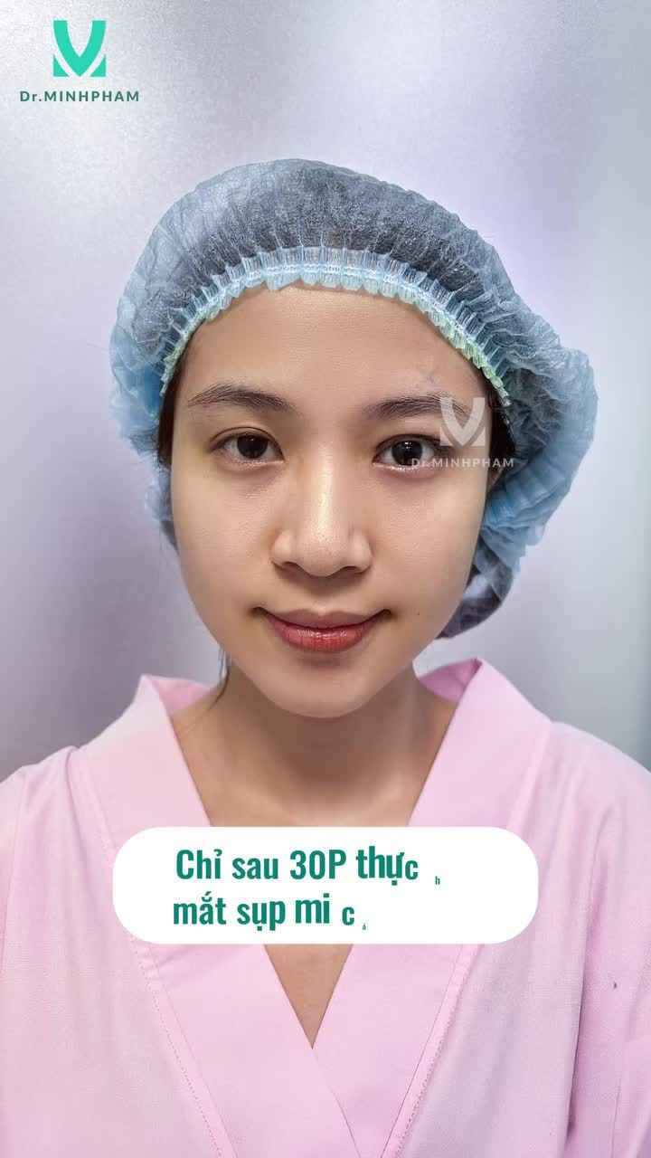 Hành trình phẫu thuật Thu ngắn cơ nâng mi lấy lại tự tin cho đôi mắt của bạn Phương Anh