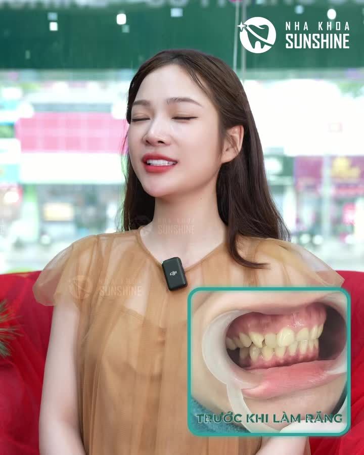 Khách hàng thẩm mỹ 18 răng sứ tại Sunshine