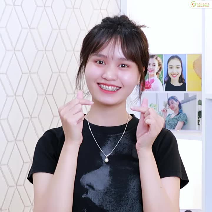 Từ cô giảng viên từng e dè khi cười… đến nụ cười rạng rỡ sau gần 1 năm niềng răng tại Viet Smile.