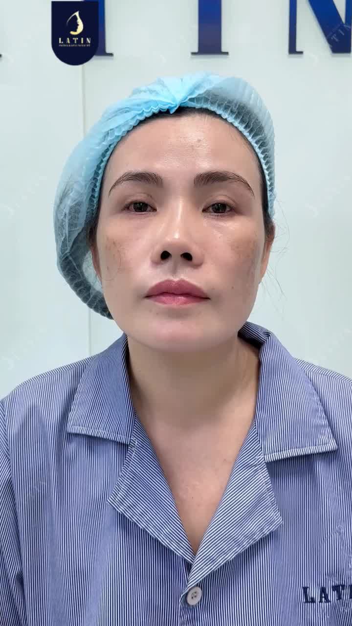 CÁNH MŨI TỰ NHIÊN VÀO PHOM DÙ KHÔNG CAN THIỆP ĐẾN