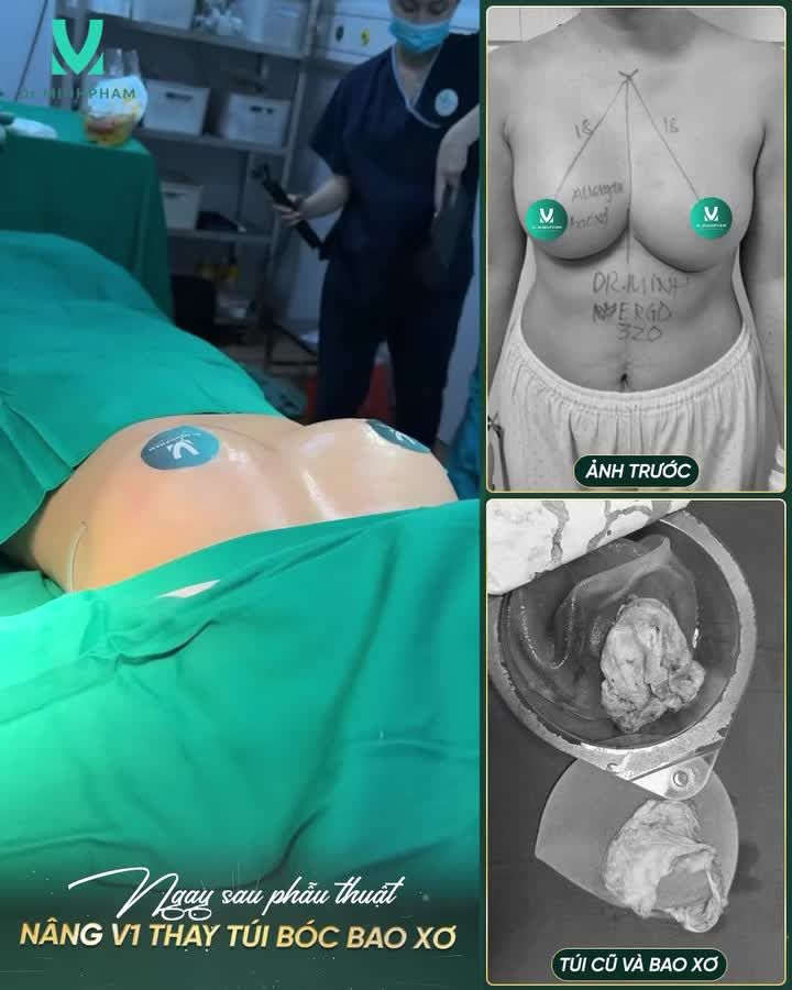 LẠI 1 CASE THÁO TÚI ALLERGAN BÓC BAO XƠ DO TRỰC TIẾP DR. MINH PHẠM THỰC HIỆN