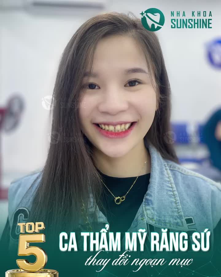 TOP 5 CA THẨM MỸ RĂNG SỨ THAY ĐỔI NGOẠN MỤC TRONG Tháng 11