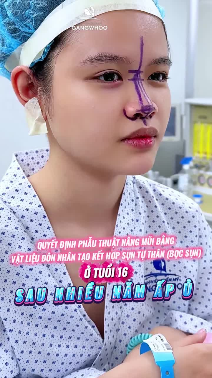 Quyết định phẫu thuật nâng mũi bằng vật liệu độn nhân tạo kết hợp sụn tự thân (bọc sụn) ở tuổi 16 sau nhiều năm ấp ủ