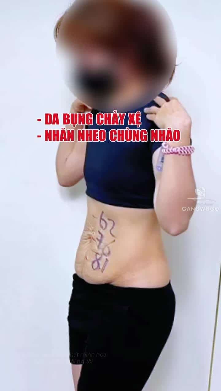 Ứng dụng công nghệ nội 4K trong phẫu thuật căng da bụng có cắt rời và di chuyển rốn giúp khách hàng nhanh hồi phục, hạn chế đau tối đa và kết quả luôn đẹp.