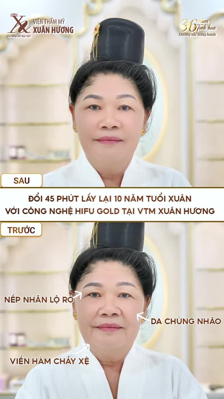DA CHÙNG NHÃO, CHẢY XỆ DO LÃO HOÁ, CẢI THIỆN HOÀN TOÀN CHỈ SAU 1 BUỔI THỰC HIỆN HIFU GOLD