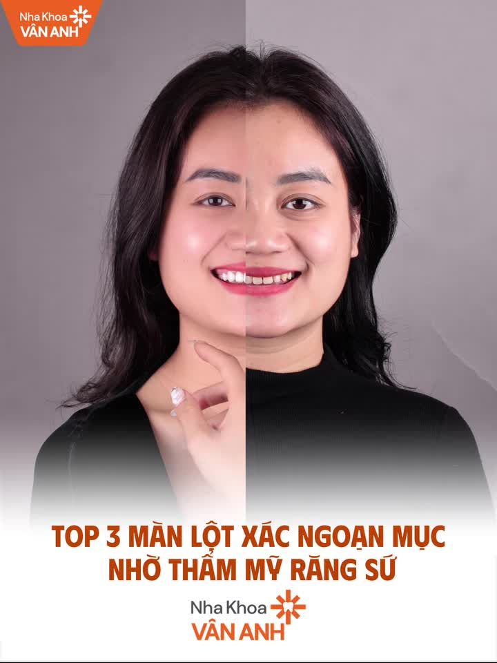 TOP 3 MÀN LỘT XÁC NGOẠN MỤC KHI LÀM RĂNG SỨ TẠI NHA KHOA VÂN ANH