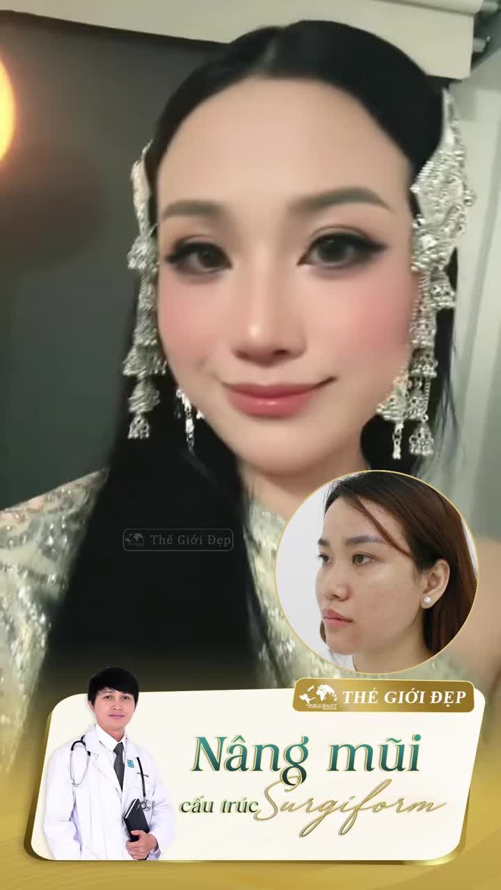Lột xác dung mạo với dáng mũi chuẩn tỉ lệ vàng bằng phẫu thuật nâng mũi cấu trúc!