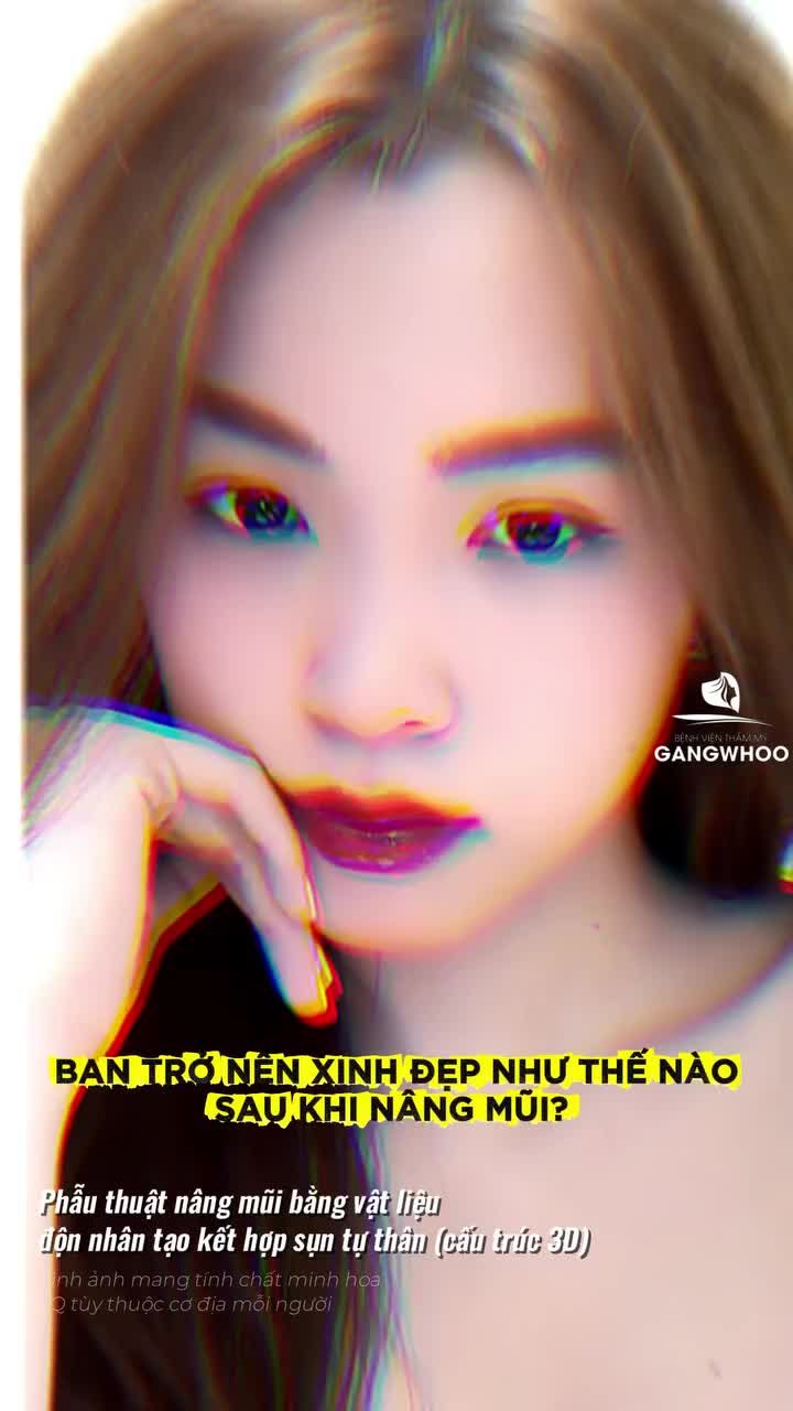Bạn trở nên xinh đẹp như nào sau khi phẫu thuật nâng mũi bằng vật liệu độn nhân tạo kết hợp sụn tự thân