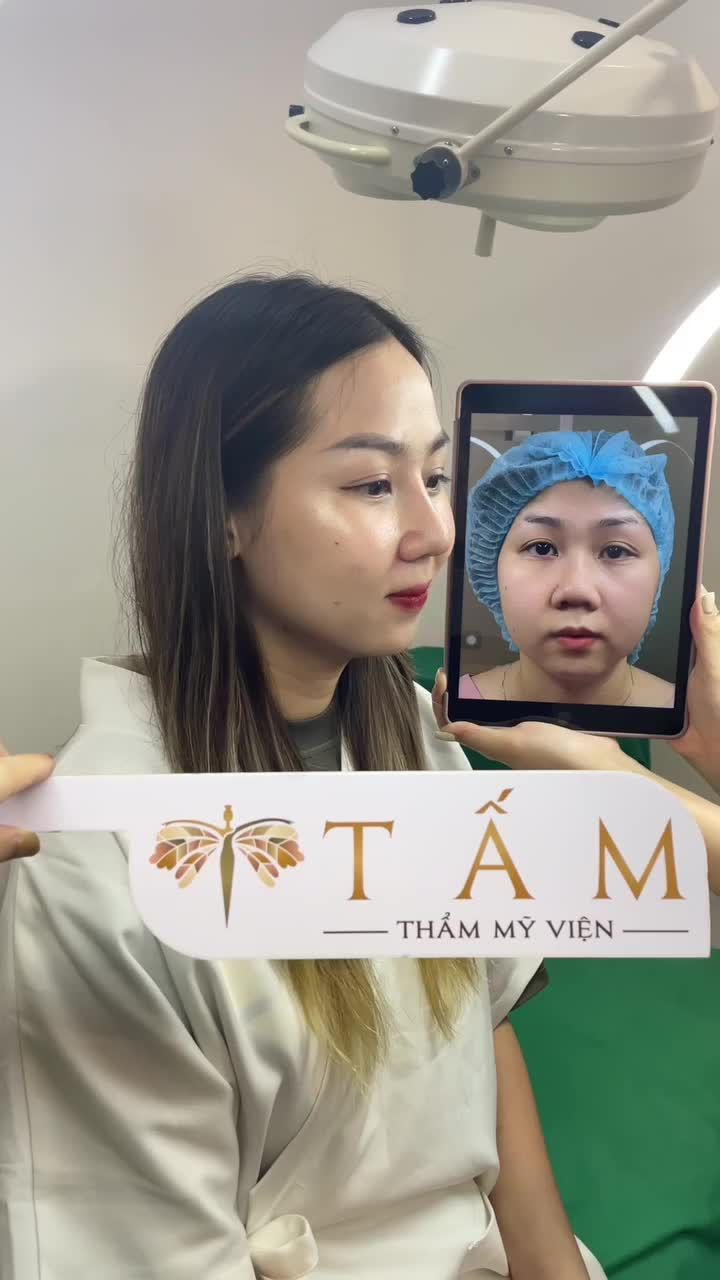 Đã nâng mũi chỉ cách đây 1 năm nhưng chưa thật sự ưng ý... Trinh quyết định nâng lại mũi tại TMV Tấm.