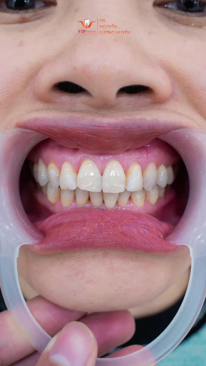 Chỉ cần thẩm mỹ răng sứ, bạn đã có thể thay đổi hoàn toàn nụ cười: