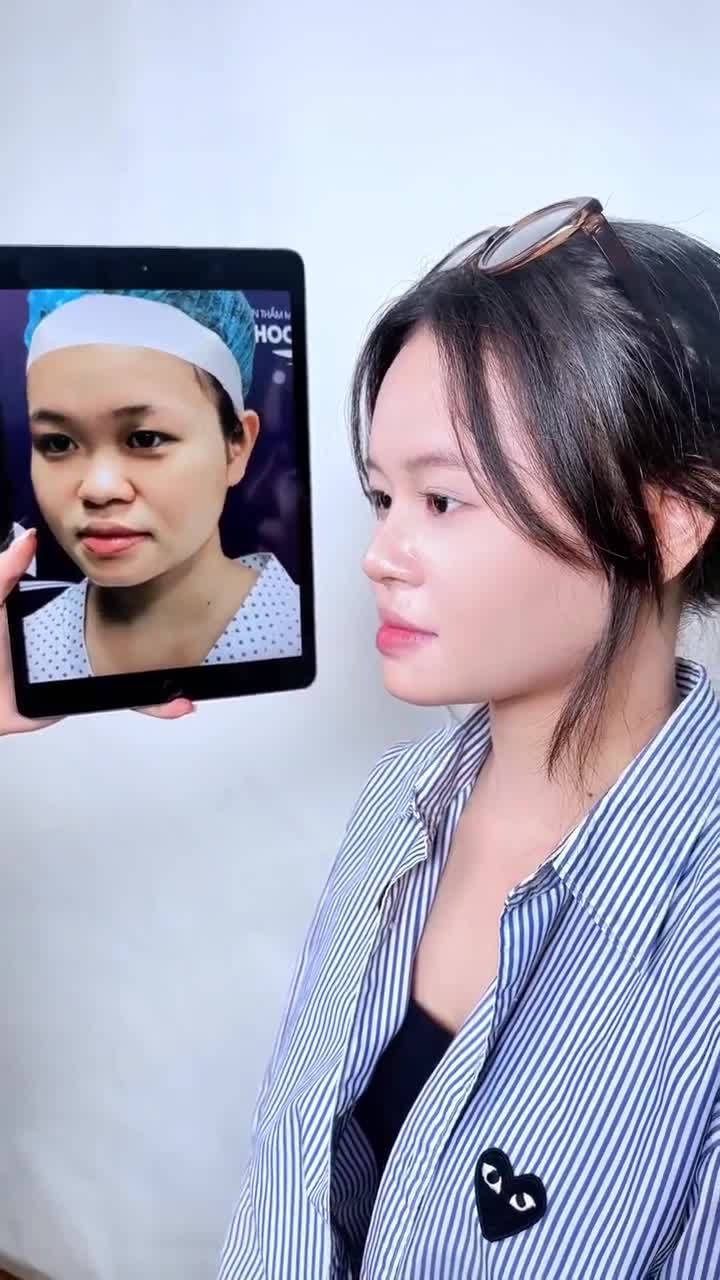 Sáng nay, sóng livestream của gangwhoo mang đến một câu chuyện rất dễ thương của quỳnh – cô gáI trẻ mớI nâng mũI được 4 tháng, nhưng cuộc sống đã đổI khác rõ rệt.