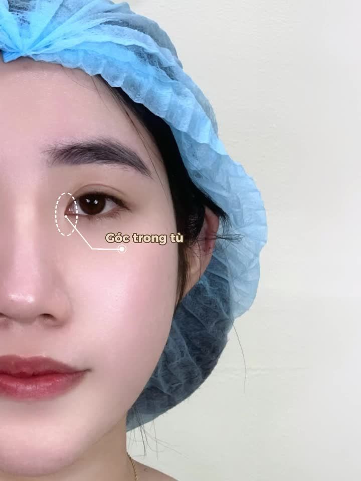 Không nghĩ chỉ can thiệp có chút ở mắt mà đã thay đổi toàn bộ gương mặt Vẫn là nét riêng ấy nhưng trông tươi tắn và cuốn hút hơn hẳn