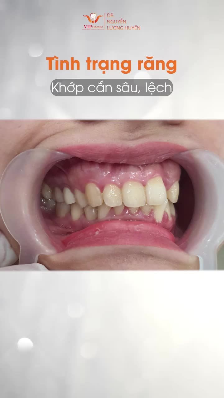 RĂNG ĐỀU ĐẸP - CHUẨN KHỚP CẮN - TỰ TIN RẠNG RỠ SAU KHI THỰC HIỆN COMBO “CHỈNH NHA VÀ LASER LỢI” TẠI VIP DENTIST !