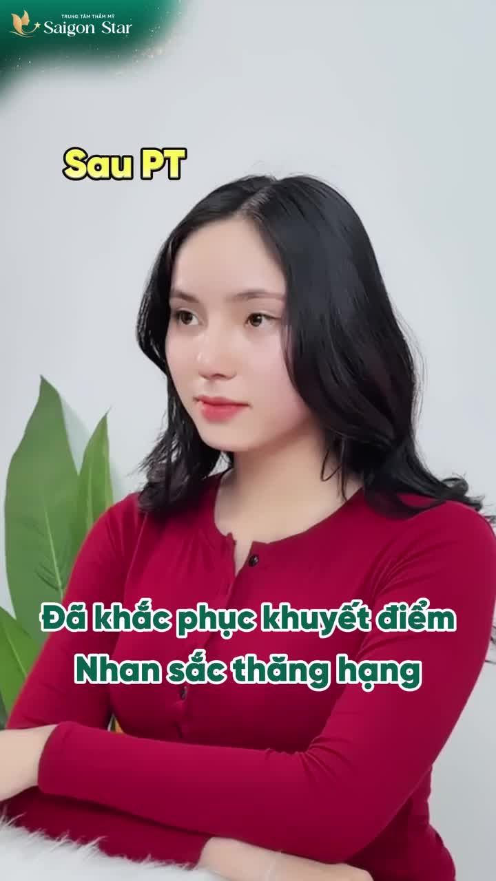 NÂNG MŨI CẤU TRÚC - KHẮC PHỤC SÓNG THẤP - ĐẦU MŨI TO BÈ.