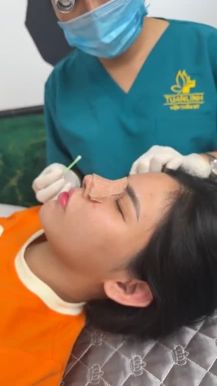 Mũi tái cấu trúc sau 10 ngày
