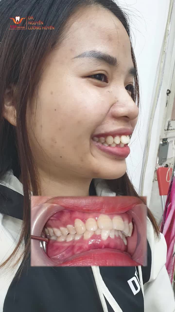 "Tháo niềng xong là mình cứ cười mãi thôi!"